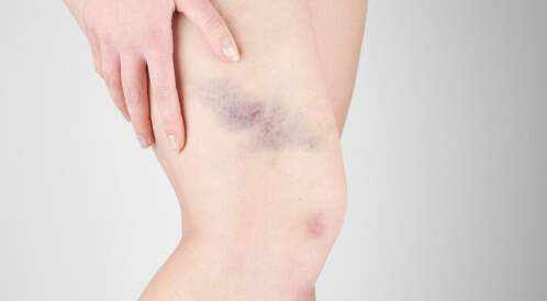 أسباب ظهور بقع زرقاء على الفخذ
