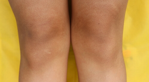 التقشير البارد للركب: لتفتيح الركب