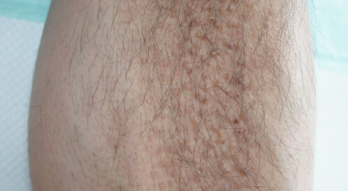 علاج تصبغات الأميلويد: إليك أبرز الطرق