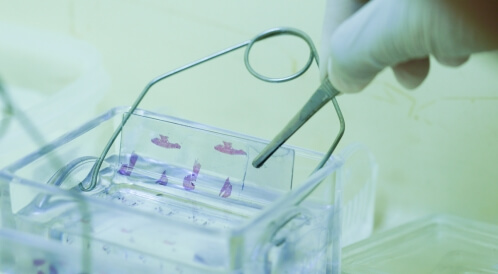 تحليل فقر الدم المنجلي: ما هو؟