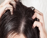 فطريات قشرة الشعر: دليلك الشامل