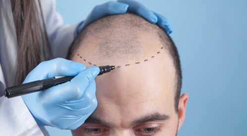 هل زراعة الشعر ناجحة؟