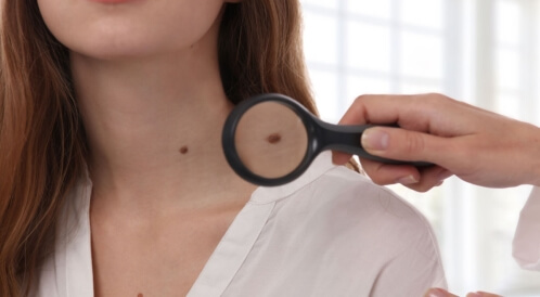 أنواع البقع الجلدية: إليك أهمها