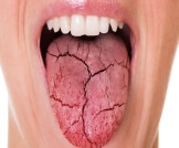 أسباب جفاف الفم عند النساء