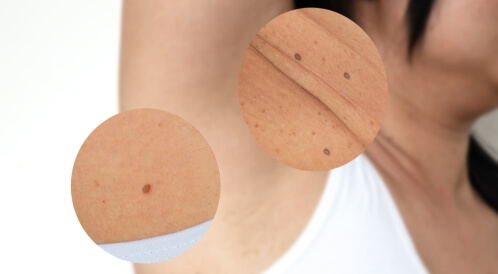 زوائد جلدية تحت الإبط: هل هي أمر خطير؟