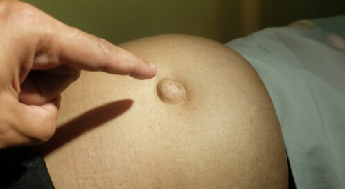 انتفاخ البطن فوق السرة للحامل