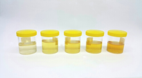 البول الأبيض: أهم المعلومات