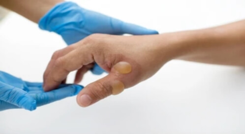 بثور: ما هي؟