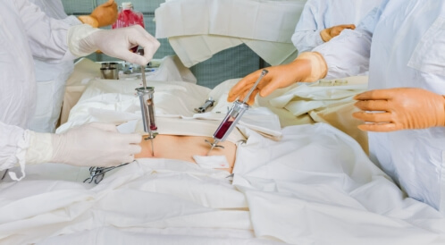 عملية زرع النخاع لمرضى سرطان الدم