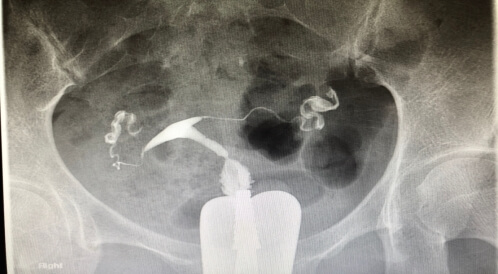 فحص hsg: كل ما يتعلق به