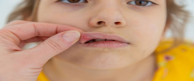 علاج التهاب الفم الفيروسي عند الأطفال