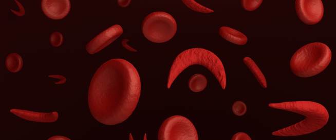 فقر الدم المنجلي: الأعراض، الأسباب والعلاج