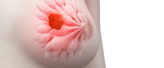 سرطان الثدي: الأعراض، والأسباب، والعلاج