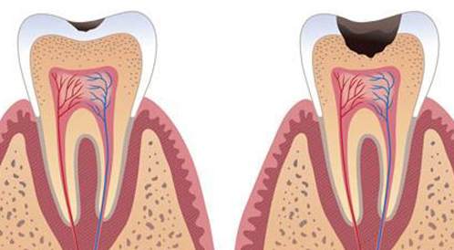 تسوس الأسنان: الأسباب، الأعراض والعلاج - ويب طب
