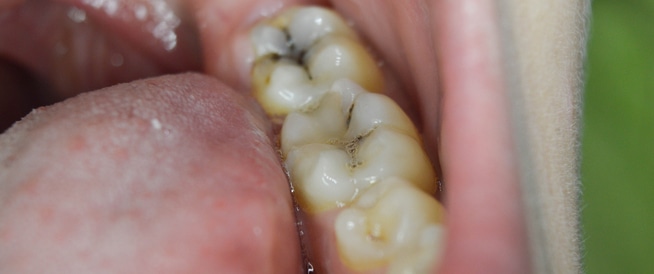 تسوس الأسنان: الأسباب، الأعراض والعلاج