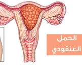 الحمل العنقودي