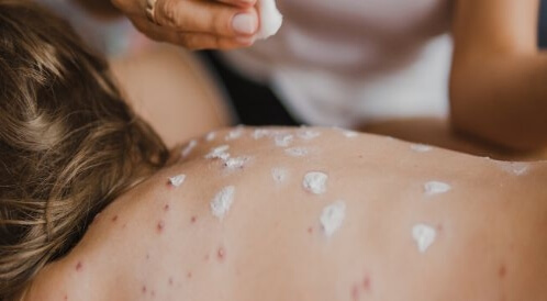 كل ما يهمك عن أعراض العنقز