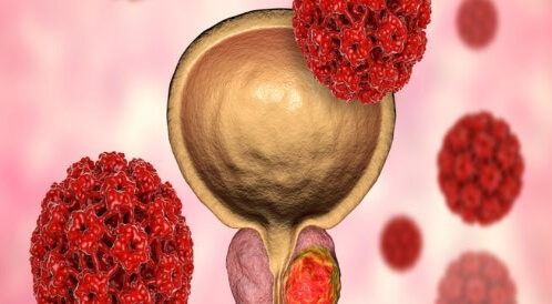 سرطان البروستاتا: ما عليك معرفته