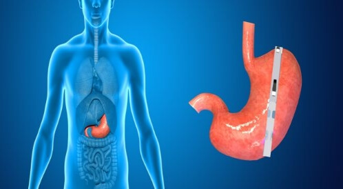 بكلة المعدة: أحدث تقنية لإنقاص الوزن دون قص المعدة