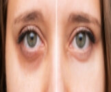 الهالات السوداء تحت العين: أسبابها وطرق علاجها