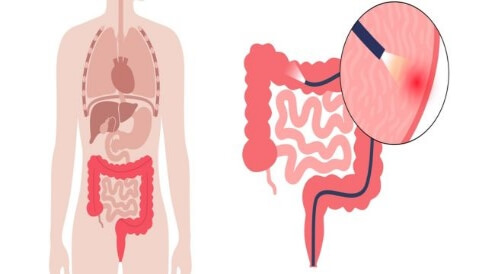 عمرك 45 فما فوق؟ عليك إجراء تنظير للقولون