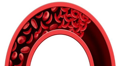 اختراق طال انتظاره: العلاج الجيني الحديث لفقر الدم المنجلي - فهم الإمكانيات والحدود!