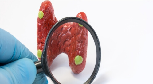 ما هي أعراض ورم الغدة الجار درقية؟