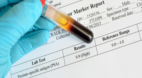 هل ارتفاع PSA يعني سرطان؟