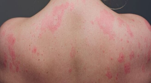 الطفح الجلدي عند الكبار: متى يتطلب مراجعة الطبيب؟