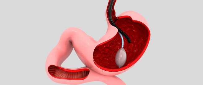 تعرّف على بالونات المعدة: فوائدها وأشهر أنواعها