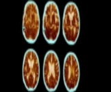 دراسة جديدة تربط بين أحد أنواع خلايا المناعة ومرض ألزهايمر