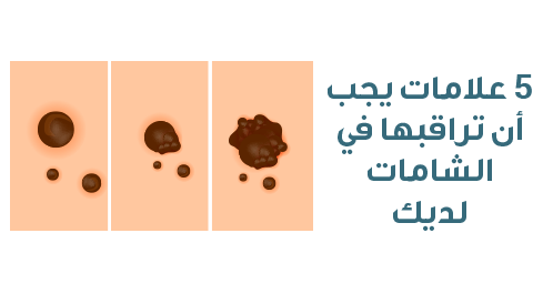 5 علامات يجب أن تراقبها في الشامات لديك