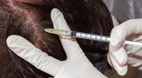 شاهد بالفيديو: عملية زراعة الشعر