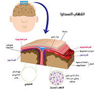 التهاب السحايا: الأسباب، الأعراض والعلاج