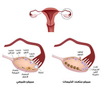 أكياس على المبايض: الأسباب، الأعراض والعلاج