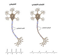 التصلب اللويحي: الأعراض، والأسباب، والعلاج