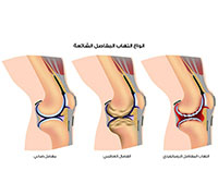 مرض التهاب المفاصل: الأسباب، والأعراض، والعلاج