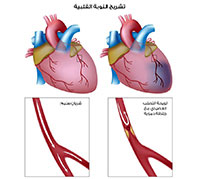 الذبحة الصدرية: الأسباب، الأعراض والعلاج