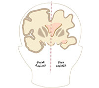 مرض الزهايمر: الأعراض، والأسباب، والعلاج