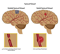 اعراض الجلطة في الراس