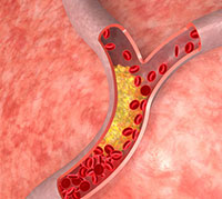 كوليسترول في الشريان