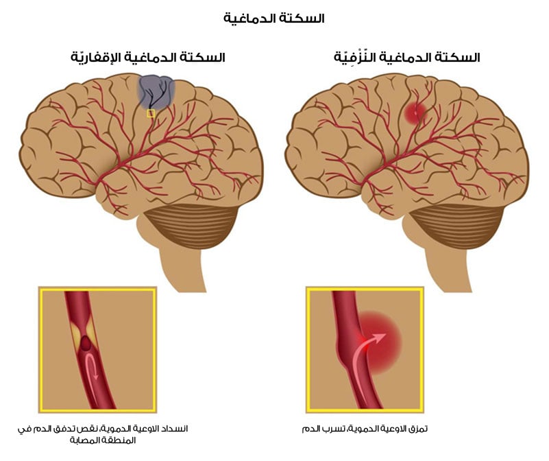 الم الظهر