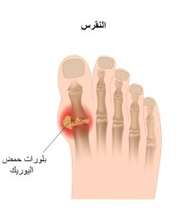 النقرس: الأسباب، الأعراض والعلاج