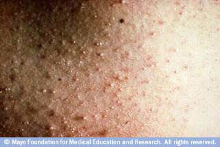 5. طفح الحرارة