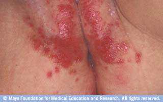 2. طفح الحفاض