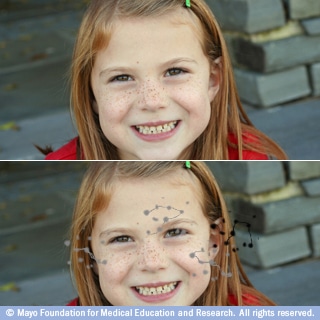 الإبصار مع البقع العائمة