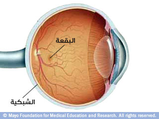 التنكس البقعي