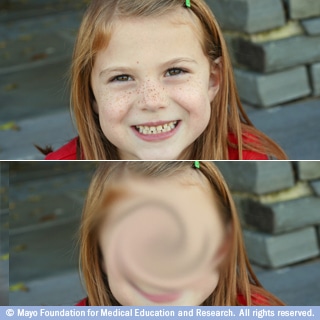 الإبصار في التنكس البقعي