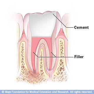 إبصار الذين يُعانون من الساد