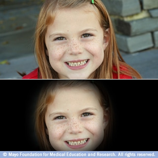 الإبصار لدى الذين يُعانون من زرق العين